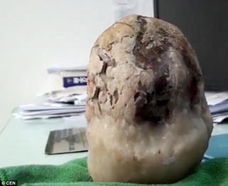 Kinh hoàng sỏi mật nặng hơn 1kg