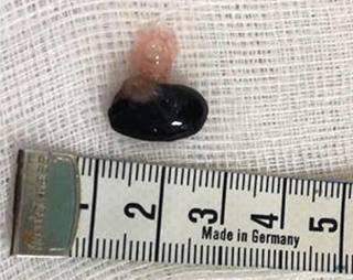 Bé 3 tuổi ngưng tim, ngưng thở vì hóc hạt mãng cầu