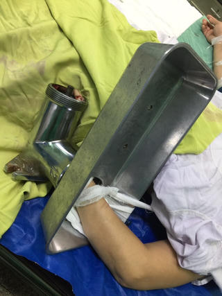 Gần 60 phút phẫu thuật cứu bàn tay bị máy xay thịt nghiền nát