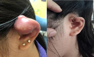 Mưng mủ vì bấm lỗ tai không bảo đảm vô trùng