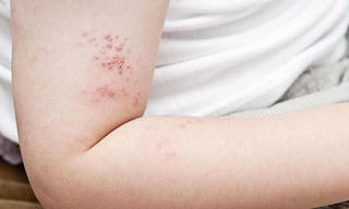 Cảnh báo ngộ độc thuốc điều trị da liễu cấp tính