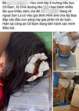 Hà Tĩnh: Điều tra thông tin bé gái bị cha dượng bạo hành bằng búa