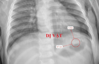 Bé 10 tháng tuổi suýt thủng ruột vì nuốt điếu thuốc lá có mảnh kim loại