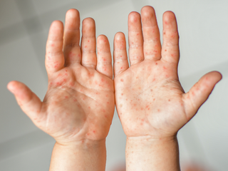 Sở Y tế TPHCM cảnh báo tác nhân EV71 xuất hiện trở lại