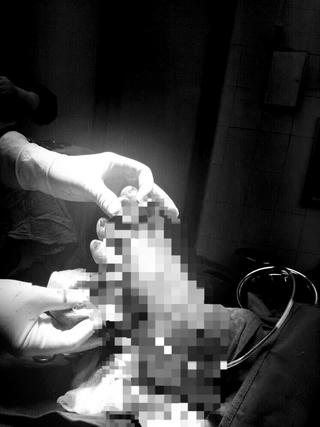 Quảng Trị: Phẫu thuật thành công ca đứt bàn chân nghiêm trọng