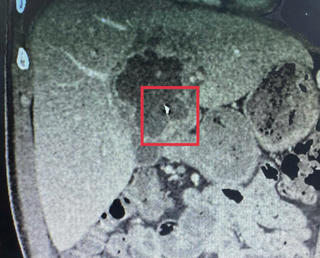 Lấy thành công kim khâu quần áo ra khỏi gan một bệnh nhân  