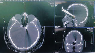 Cứu sống người bệnh tự đâm kéo xuyên đầu 