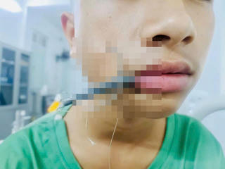 Nghệ An: Kịp thời cứu bé trai bị lưỡi câu cắm sâu vùng mặt